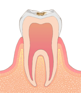 宮下歯科室　虫歯C1